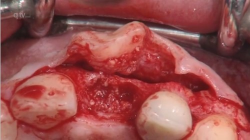 Anterior implant with concurrent bone augmentation (GBR) by Ueli Grunder