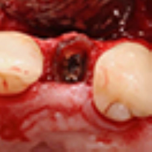 Implants in the partially edentulous anterior region - Online lecture
