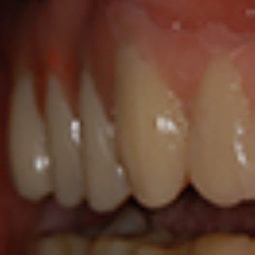 Choice of type of reconstruction in esthetic and non-esthetic areas