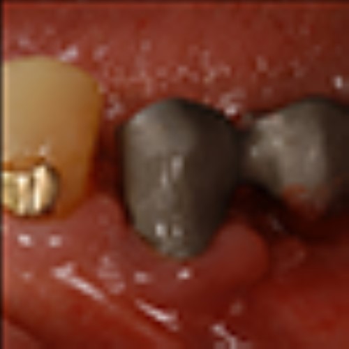Choice of type of fixation: screw-retained vs. cemented reconstructions