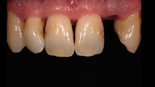 Immediate Implant placement in the esthetic area