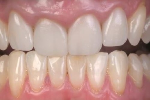 Immediate placement and all-ceramic restoration in the anterior maxilla-a customized interdisciplinary treatment approach-Clinical procedure