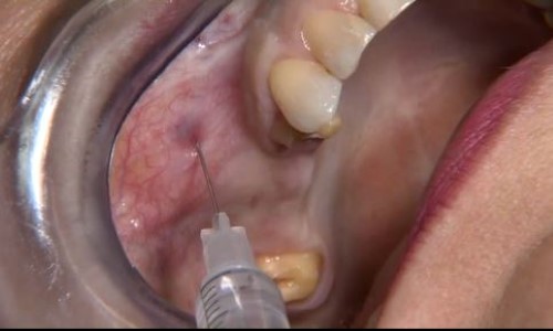 Innovative CAD/CAM treatment approaches for implant-supported fixed restorations